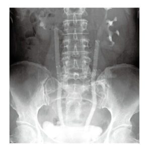 Rayos X de stent ureteral
